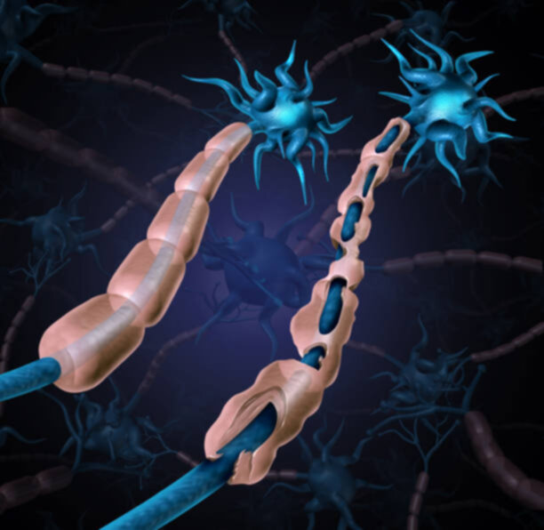 Multiple Sclerosis Detection