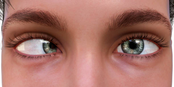 Surgical Planning for Strabismus Surgery